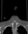 Butterfly vertebra (Radiopaedia 77903-90209 Coronal bone window 76).jpg