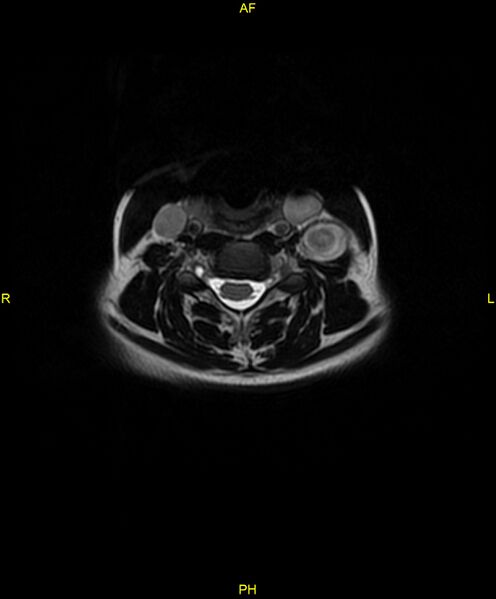 File:C5 nerve sheath tumor (Radiopaedia 85777-101596 Axial T2 37).jpg