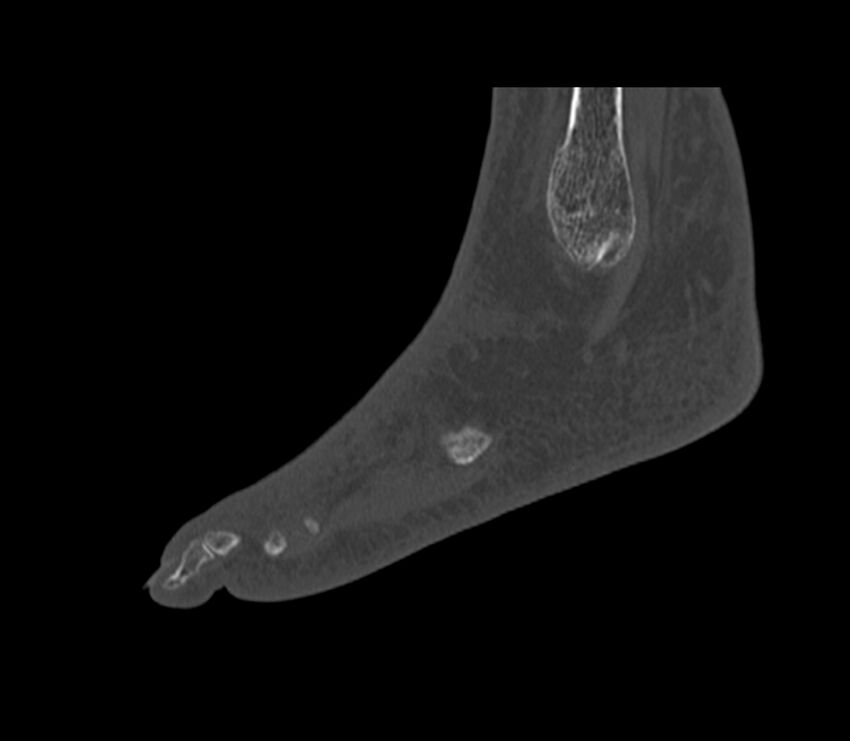 Calcaneal tuberosity avulsion fracture (Radiopaedia 22649-22668 Sagittal bone window 7).jpg