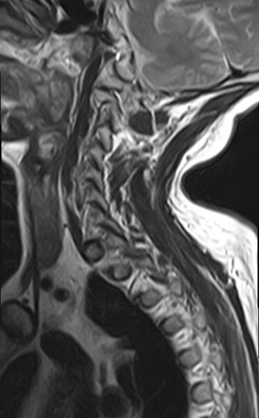 File:Calcified meningioma - cervical canal (Radiopaedia 70136-82468 Sagittal T2 4).jpg