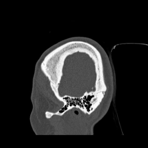 File:Calvarial osteoma (Radiopaedia 36520-38079 Sagittal bone window 14).jpg
