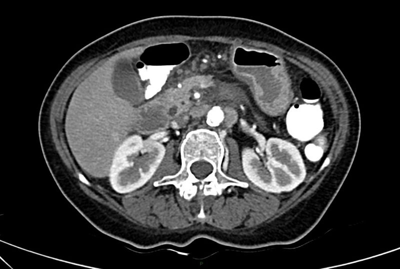 File:Carcinoid mesenteric tumor complicated by chylous ascites (Radiopaedia 76312-88926 A 27).jpg