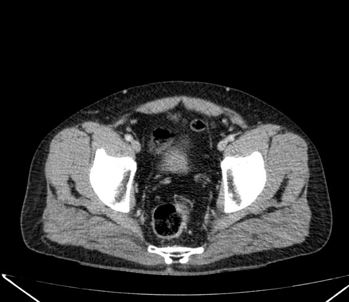 File:Carcinoid tumor with hepatic metastases (Radiopaedia 22651-22670 C 73).jpg