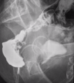 Carcinoma of rectum (Radiopaedia 27843-28085 Lateral 1).PNG