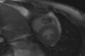 Cardiac hemangioma (Radiopaedia 31709-32631 E 40).jpg