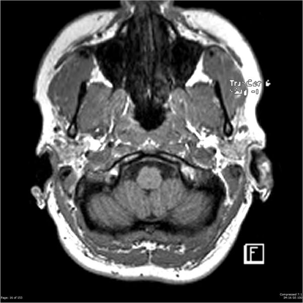File:Cavernous malformation (cavernous angioma or cavernoma) (Radiopaedia 36675-38237 Axial T1 5).jpg
