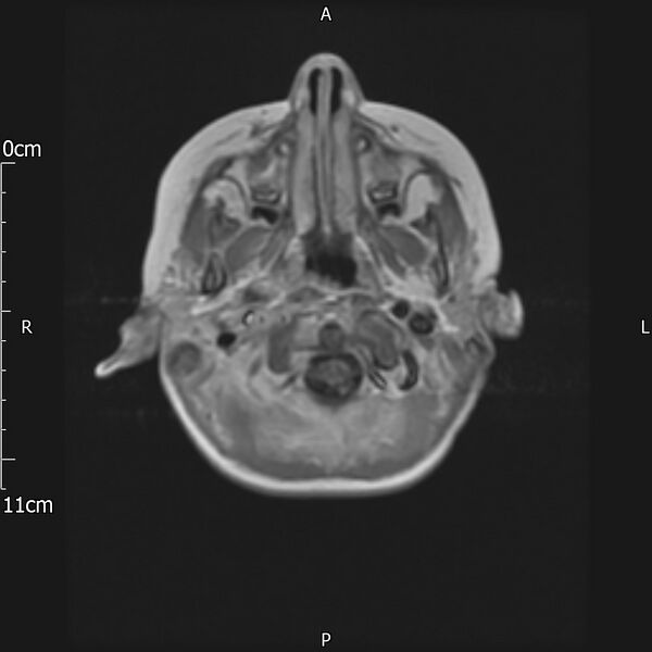 File:Cavernous sinus thrombosis (Radiopaedia 79414-92512 Axial T1 C+ 2).jpg