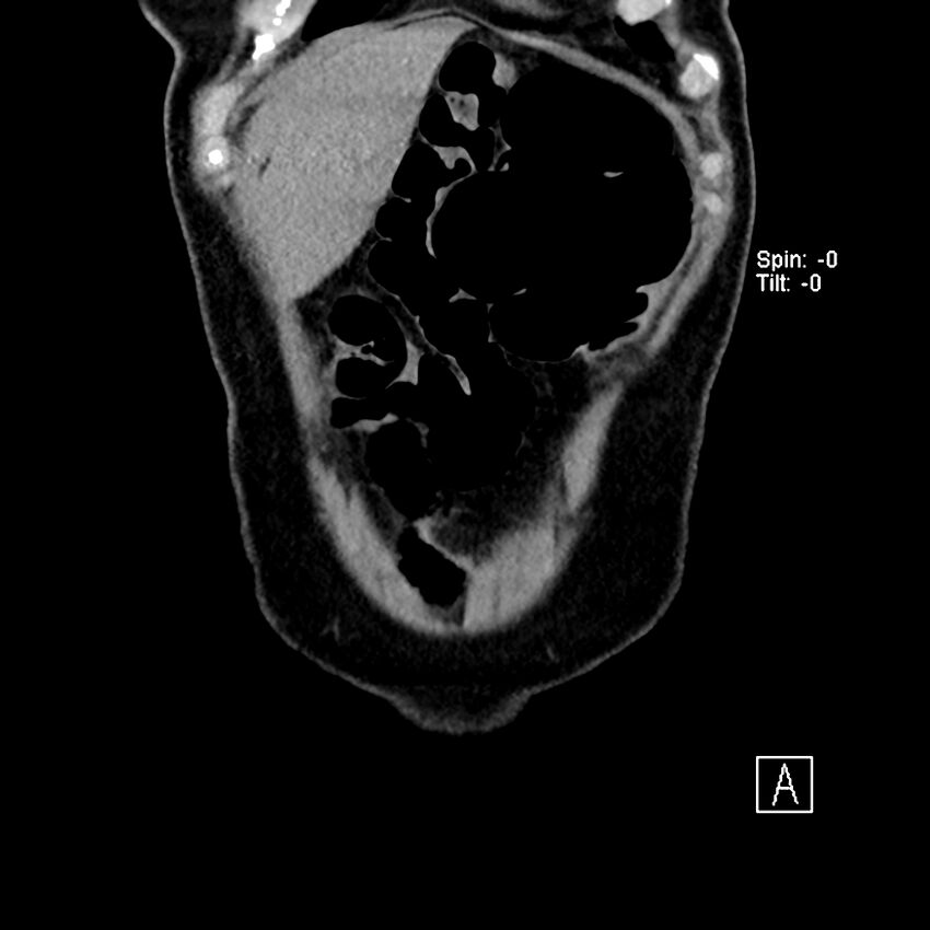 Cecal volvulus (Radiopaedia 90897-108397 Coronal non-contrast 52).jpg