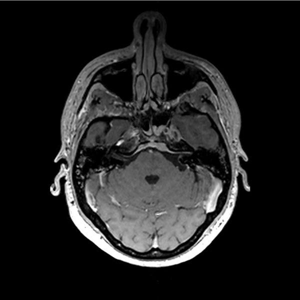 File:Central base of skull meningioma (Radiopaedia 53531-59549 Axial T1 C+ 7).jpg
