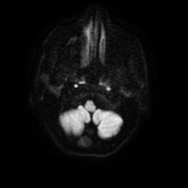 File:Central neurocytoma (Radiopaedia 67618-77021 Axial DWI 2).jpg