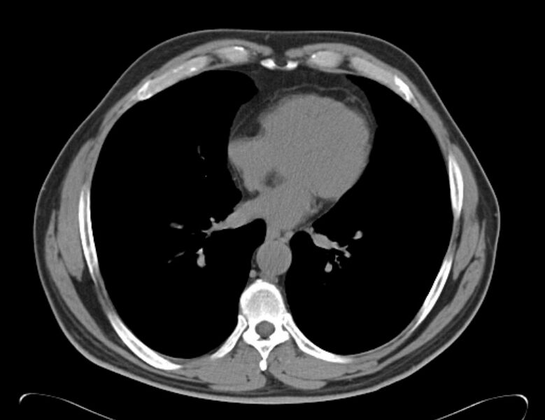 File:Centrilobular pulmonary emphysema (Radiopaedia 26808-26971 Axial non-contrast 28).jpg