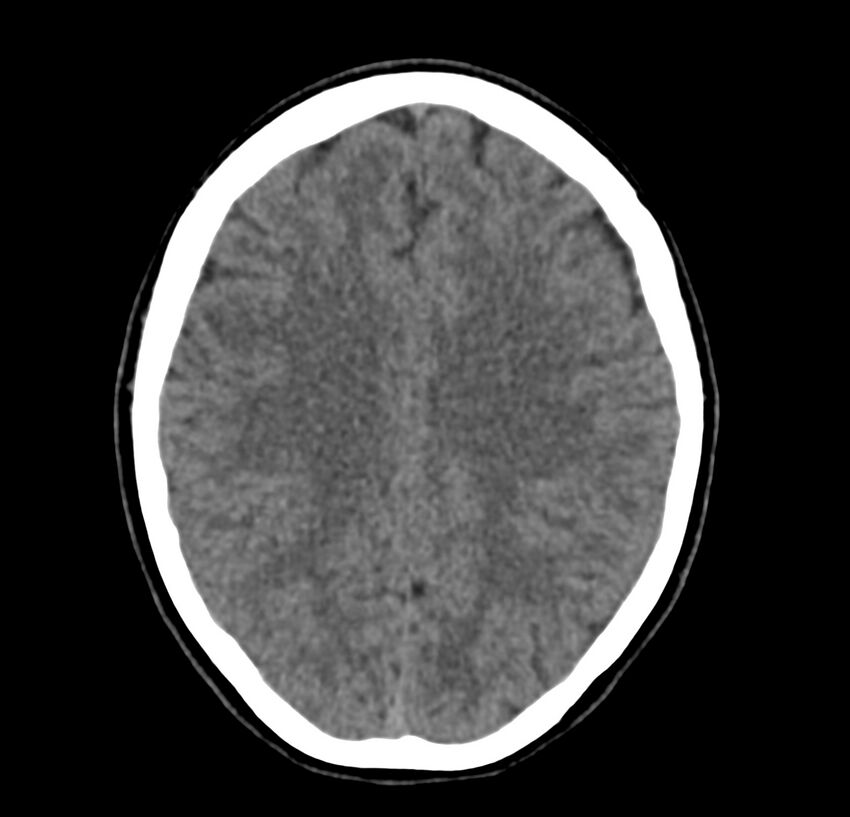 Cerebellar agenesis (Radiopaedia 30203-30817 Axial non-contrast 33).jpg