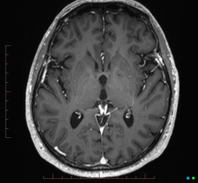 File:Cerebellar gangliocytoma (Radiopaedia 65377-74422 Axial T1 C+ 65).jpg
