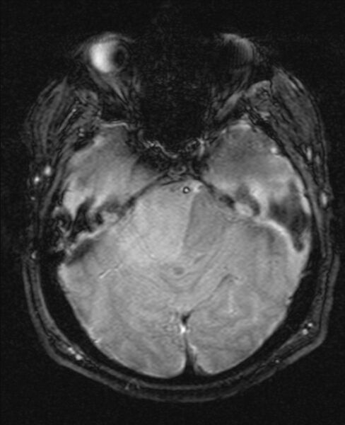 File:Cerebellopontine angle meningioma (Radiopaedia 24459-24764 Axial Gradient Echo 7).jpg