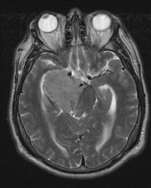 File:Cerebellopontine angle meningioma (Radiopaedia 24459-24764 Axial T2 9).jpg