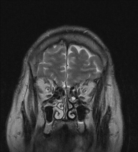 File:Cerebellopontine angle meningioma (Radiopaedia 24459-24764 Coronal T2 2).jpg