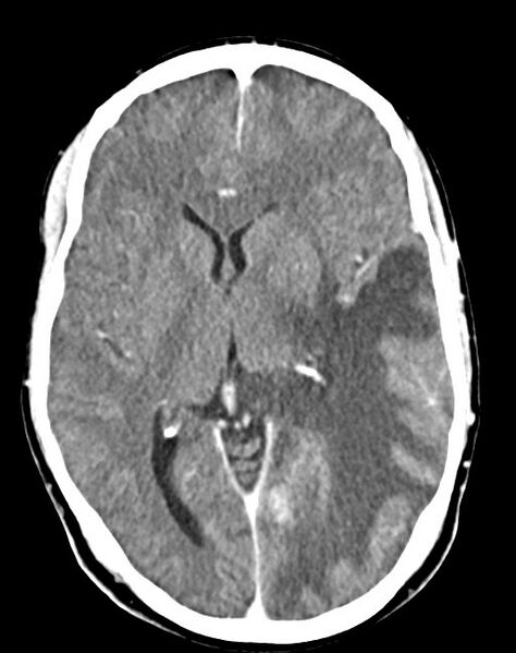 File:Cerebral abscesses (Radiopaedia 70458-80568 Axial Contrast 32).jpg