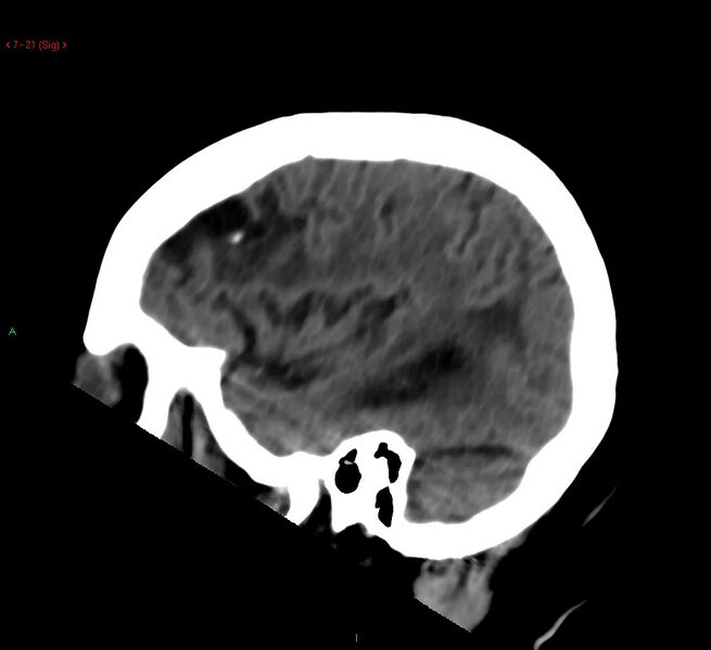 File:Cerebral amyloid angiopathy-associated lobar intracerebral hemorrhage (Radiopaedia 58378-65518 C 21).jpg