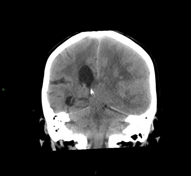 File:Cerebral amyloid angiopathy-associated lobar intracerebral hemorrhage (Radiopaedia 58561-65724 Coronal non-contrast 26).jpg