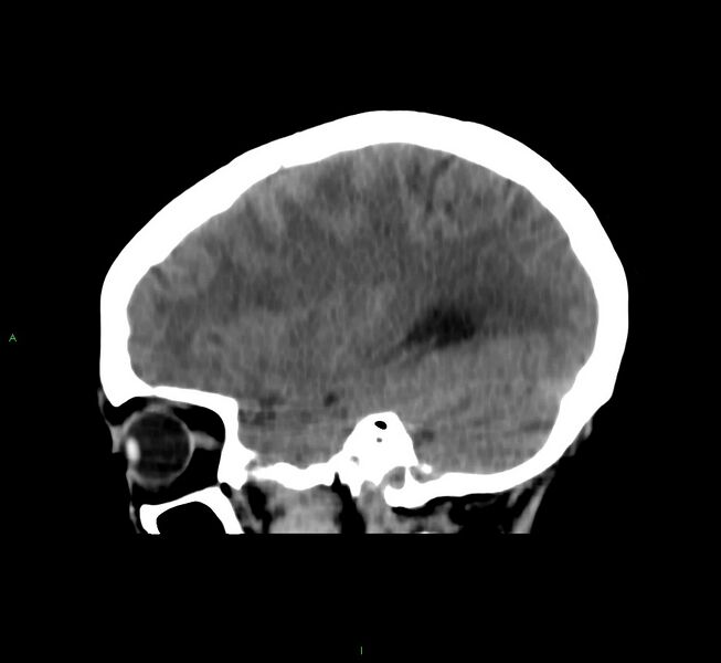 File:Cerebral amyloid angiopathy-associated lobar intracerebral hemorrhage (Radiopaedia 58566-65730 C 36).jpg