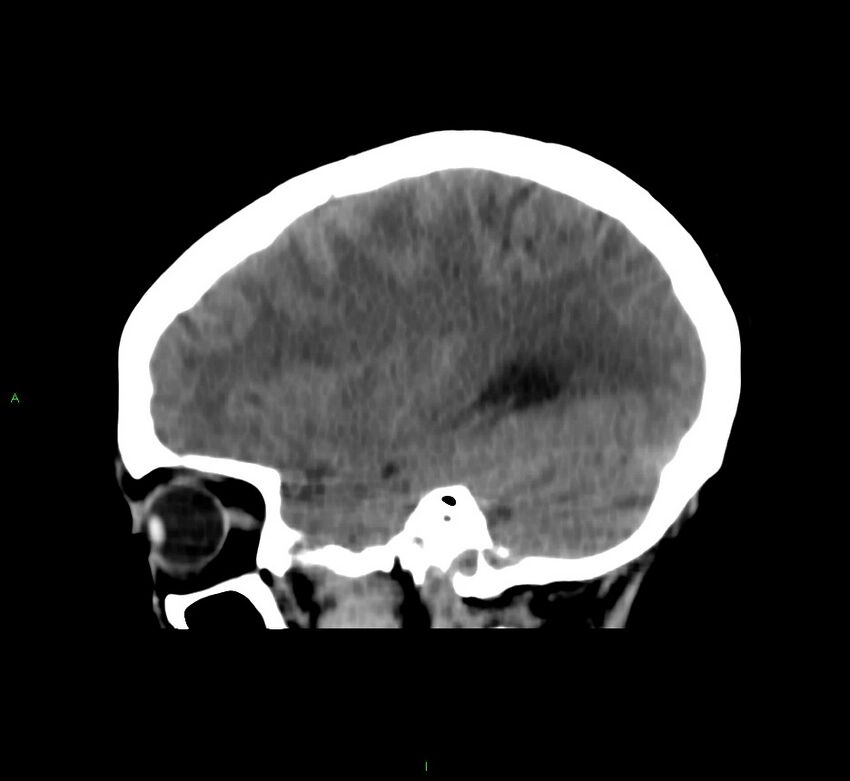 Cerebral amyloid angiopathy-associated lobar intracerebral hemorrhage (Radiopaedia 58566-65730 C 36).jpg
