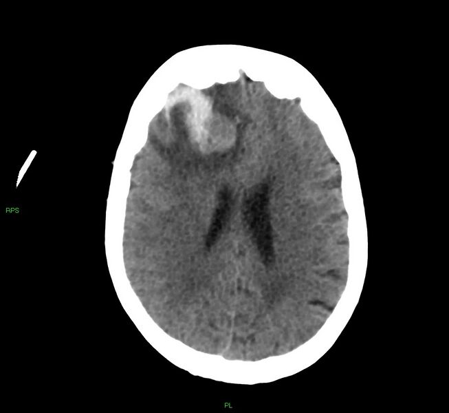 File:Cerebral amyloid angiopathy-associated lobar intracerebral hemorrhage (Radiopaedia 58569-65734 Axial non-contrast 26).jpg