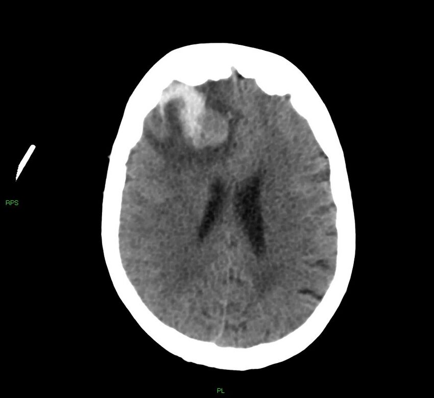Cerebral amyloid angiopathy-associated lobar intracerebral hemorrhage (Radiopaedia 58569-65734 Axial non-contrast 26).jpg