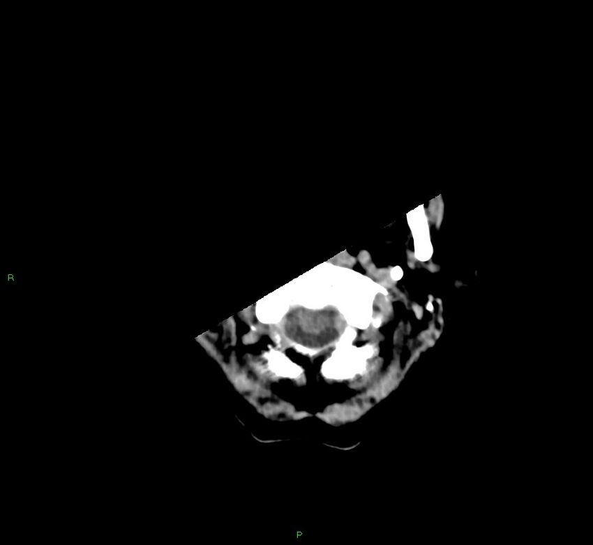 Cerebral amyloid angiopathy-associated lobar intracerebral hemorrhage (Radiopaedia 58754-65975 Axial non-contrast 56).jpg
