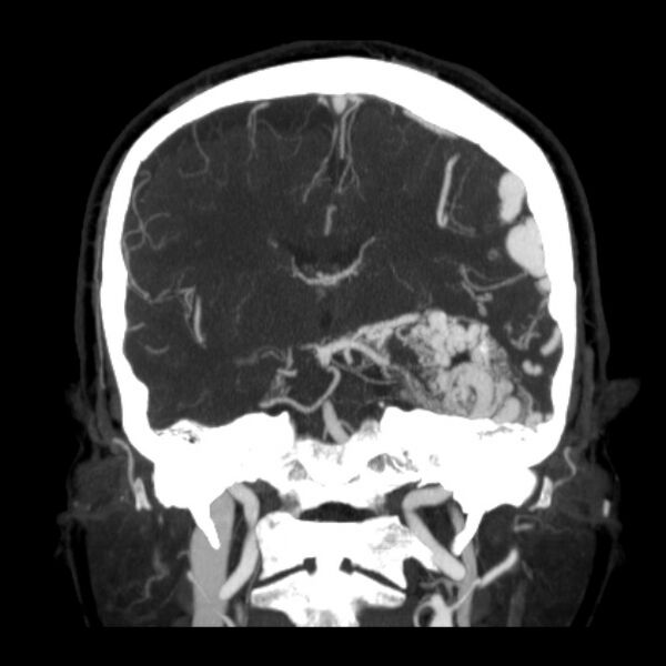 File:Cerebral arteriovenous malformation (Radiopaedia 43729-47189 C 24).jpg