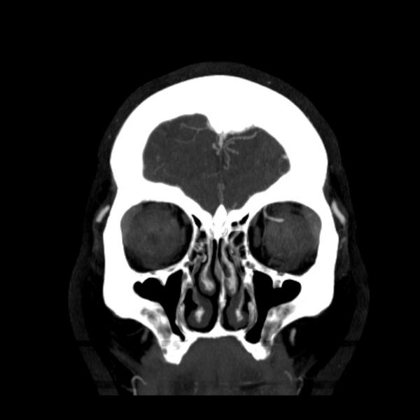 File:Cerebral arteriovenous malformation (Radiopaedia 43729-47189 C 5).jpg