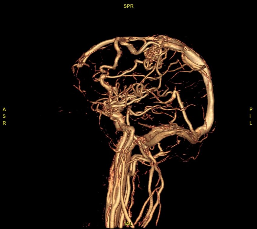 Cerebral arteriovenous malformation (Radiopaedia 61964-70029 VRT 1).jpg