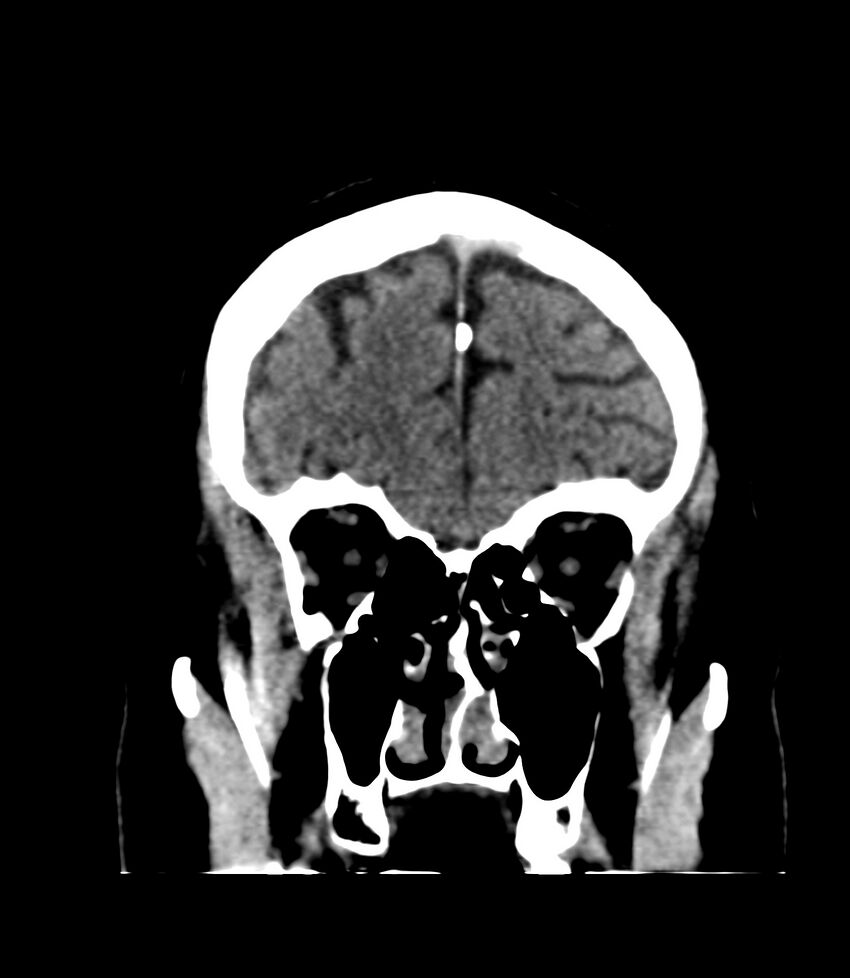 Cerebral dural venous sinus thrombosis (Radiopaedia 86514-102575 Coronal non-contrast 7).jpg