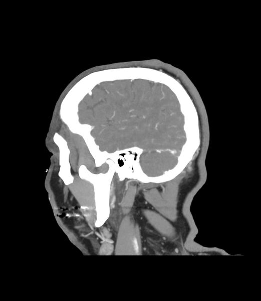 File:Cerebral dural venous sinus thrombosis (Radiopaedia 86514-102576 C 5).jpg