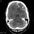 Cerebral hemorrhagic contusion with subdural and subarachnoid hemorrhage (Radiopaedia 10680-19197 Axial non-contrast 6).jpg
