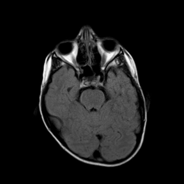 File:Cerebral tuberculoma (Radiopaedia 41152-43932 Axial FLAIR 7).jpg