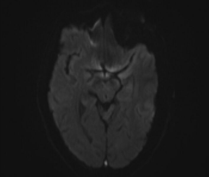 File:Cerebral venous thrombosis (Radiopaedia 71207-81504 Axial DWI 8).jpg