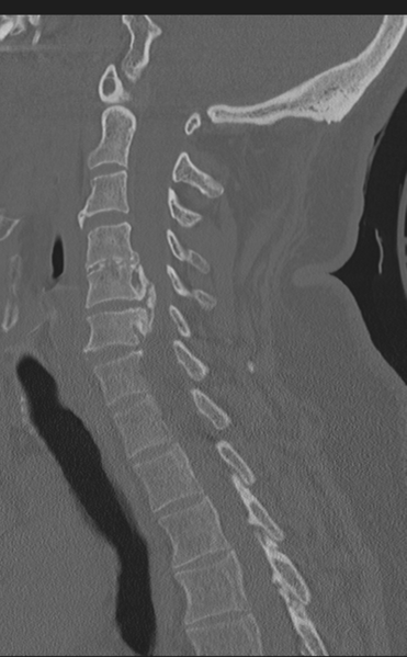 File:Cervical canal stenosis due to ossification of the posterior longitudinal ligament (Radiopaedia 47260-51823 Sagittal bone window 42).png