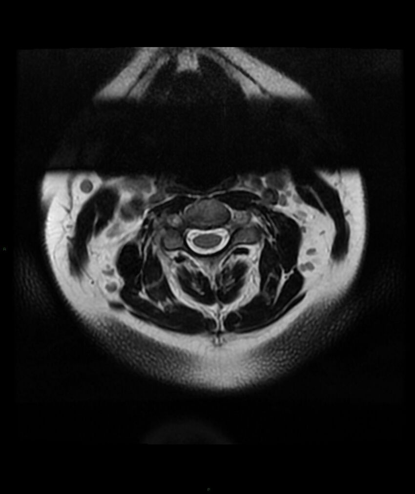 Cervical disc prolapse (Radiopaedia 80258-93598 Axial T2 2).jpg