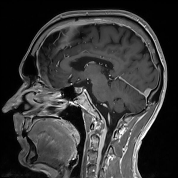 File:Cervical dural CSF leak on MRI and CT treated by blood patch (Radiopaedia 49748-54995 G 51).jpg