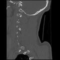 Cervical flexion teardrop fracture with cord hemorrhage (Radiopaedia 32497-33454 Sagittal bone window 8).jpg