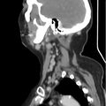 Cervical lymphadenopathy- cause unknown (Radiopaedia 22420-22457 D 31).jpg