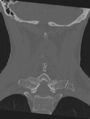 Cervical spondylolysis (Radiopaedia 49616-54811 Coronal bone window 37).png