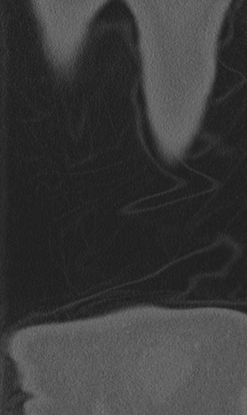 File:Chance fracture (Radiopaedia 40360-42912 Coronal bone window 77).png