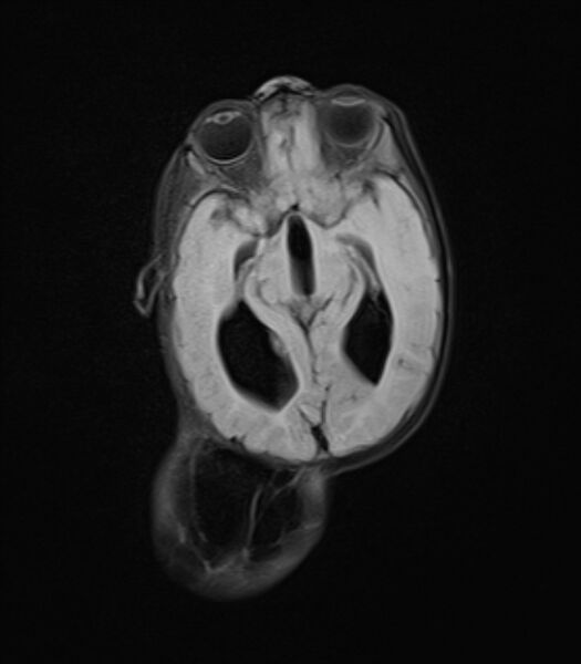 File:Chiari III malformation with occipital encephalocele (Radiopaedia 79446-92559 Axial FLAIR 14).jpg