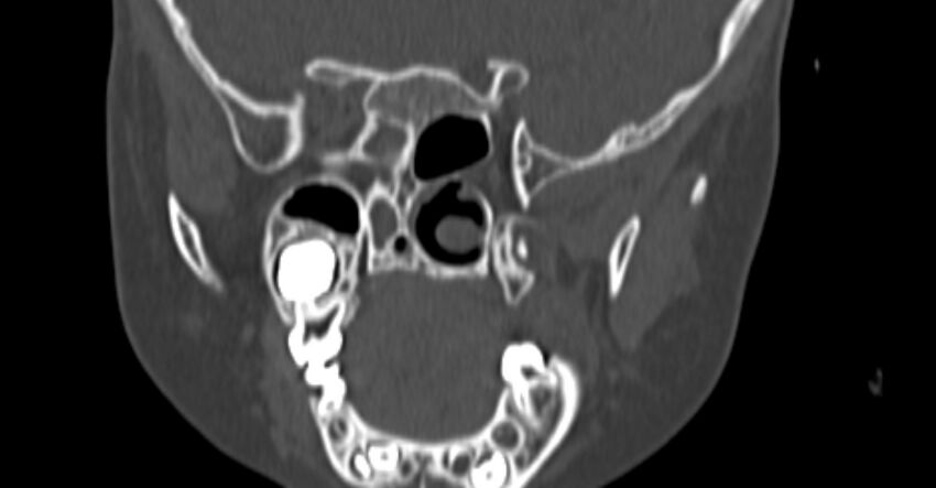 Choanal atresia (Radiopaedia 51295-56972 Coronal bone window 66).jpg