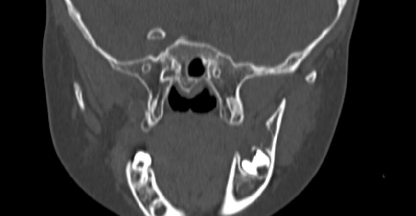 Choanal atresia (Radiopaedia 51295-56972 Coronal bone window 84).jpg
