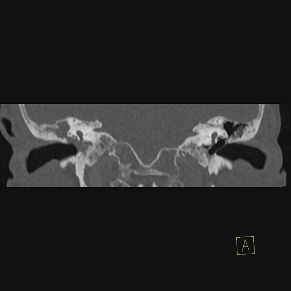File:Cholesteatomatous chronic otitis (Radiopaedia 14993-14911 Coronal bone window 7).JPEG