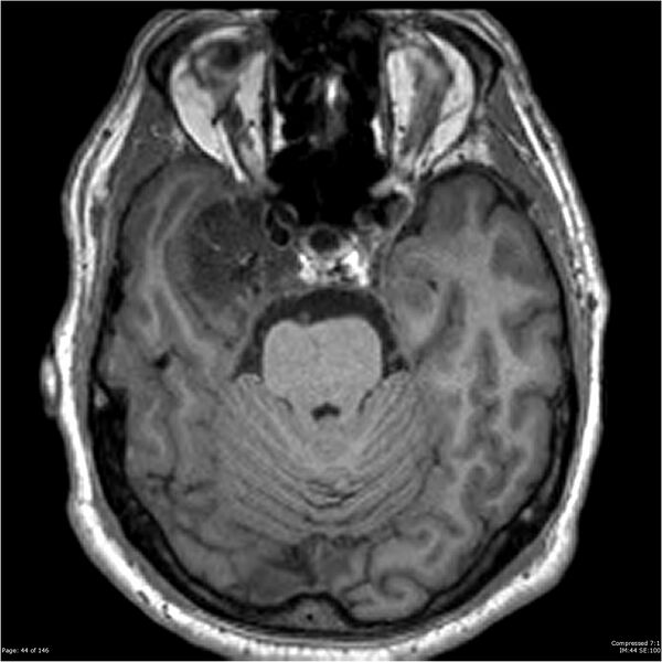 File:Chondrosarcoma of skull base- grade II (Radiopaedia 40948-43654 Axial T1 44).jpg