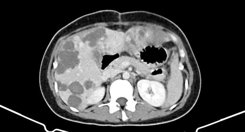 File:Choriocarcinoma liver metastases (Radiopaedia 74768-85766 A 81).jpg