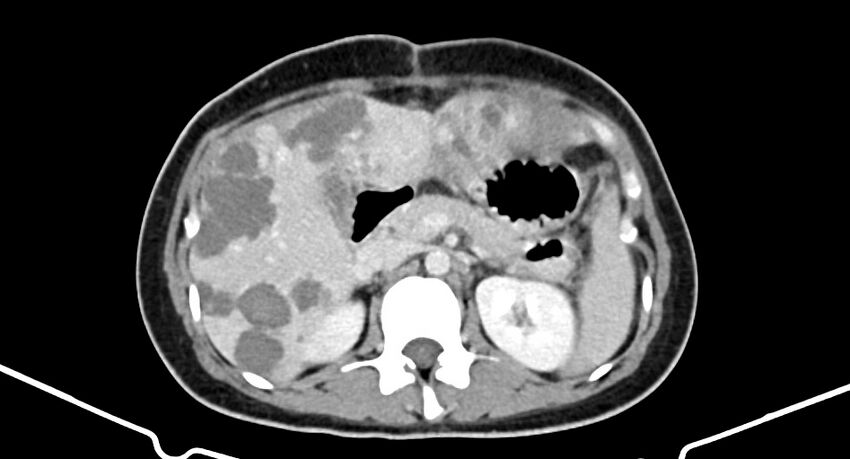 Choriocarcinoma liver metastases (Radiopaedia 74768-85766 A 81).jpg